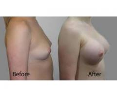 breast lift no matter how you call it difficult call mamaafica +27781179078