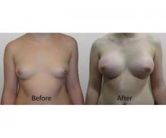 breast lift no matter how you call it difficult call mamaafica +27781179078