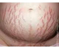 removing of body strectch marks all over the body call mamaafica +27781179078