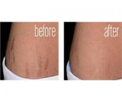 removing of body strectch marks all over the body call mamaafica +27781179078