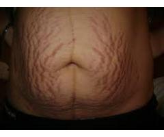 removing of body strectch marks all over the body call mamaafica +27781179078