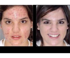 Rollyhamy removes scars, pimples, dark masks and lighten the skin permanently +2773 869 1284