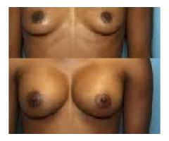Hips,bums,breasts enlargement (yodi & botcho cream) +27717274340